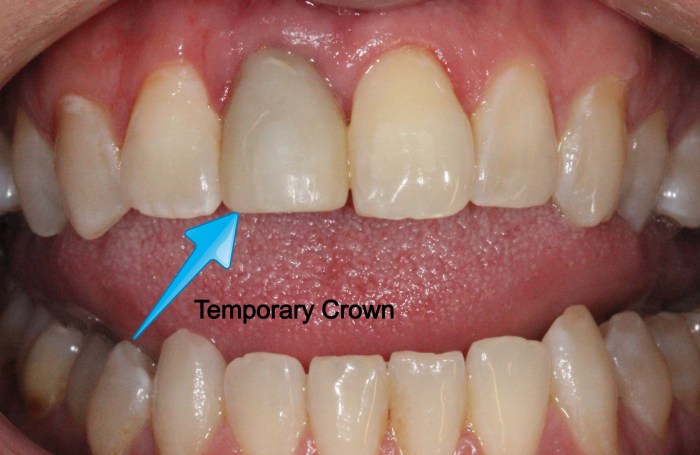 Provisional crown vs temporary crown