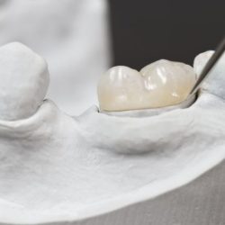 Crown zirconia ceramic metal vs better dental than material why