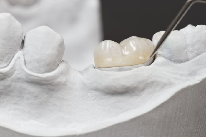 Crown zirconia ceramic metal vs better dental than material why